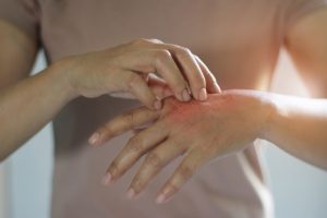 person-scratching-dry-skin-on-their-hands